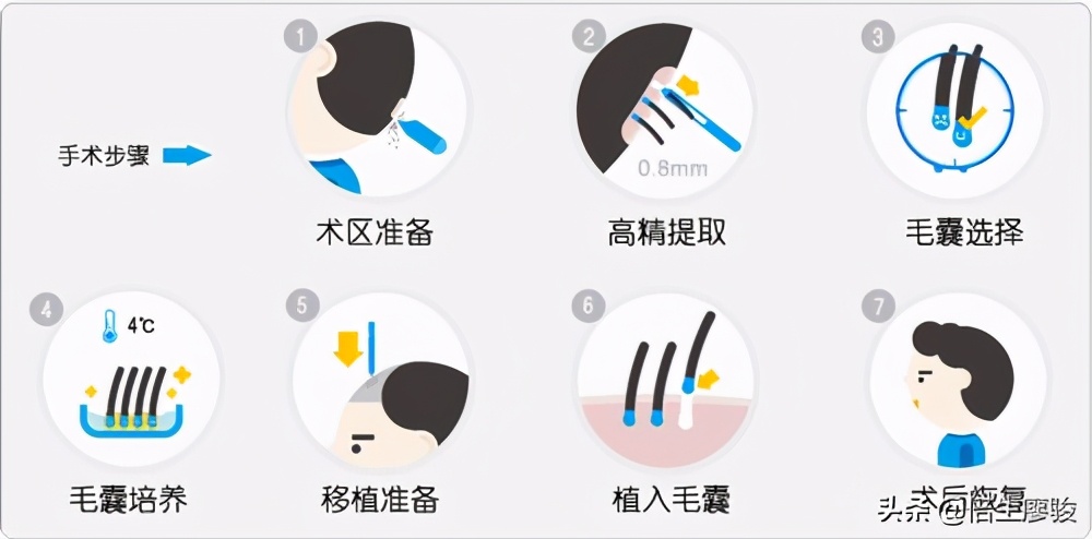 植发后尴尬期5个月后怎么办,植发后洗头植的头发掉了