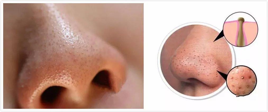 挤黑头和吸黑头哪个对毛孔损伤大,改掉挤黑头的习惯黑头会有改善吗