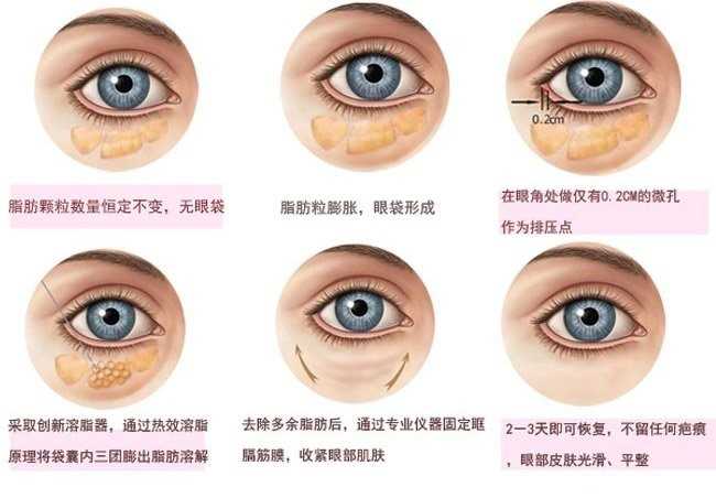 如何消除眼袋呢,如何消除眼袋浮肿