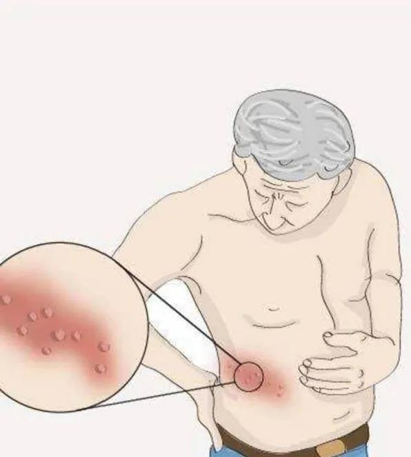 中药治疗带状疱疹并抗病毒,中医春天是带状疱疹高发期