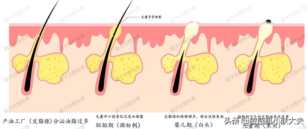 阿达帕林怎么用才正确,阿达帕林怎么用不烂脸