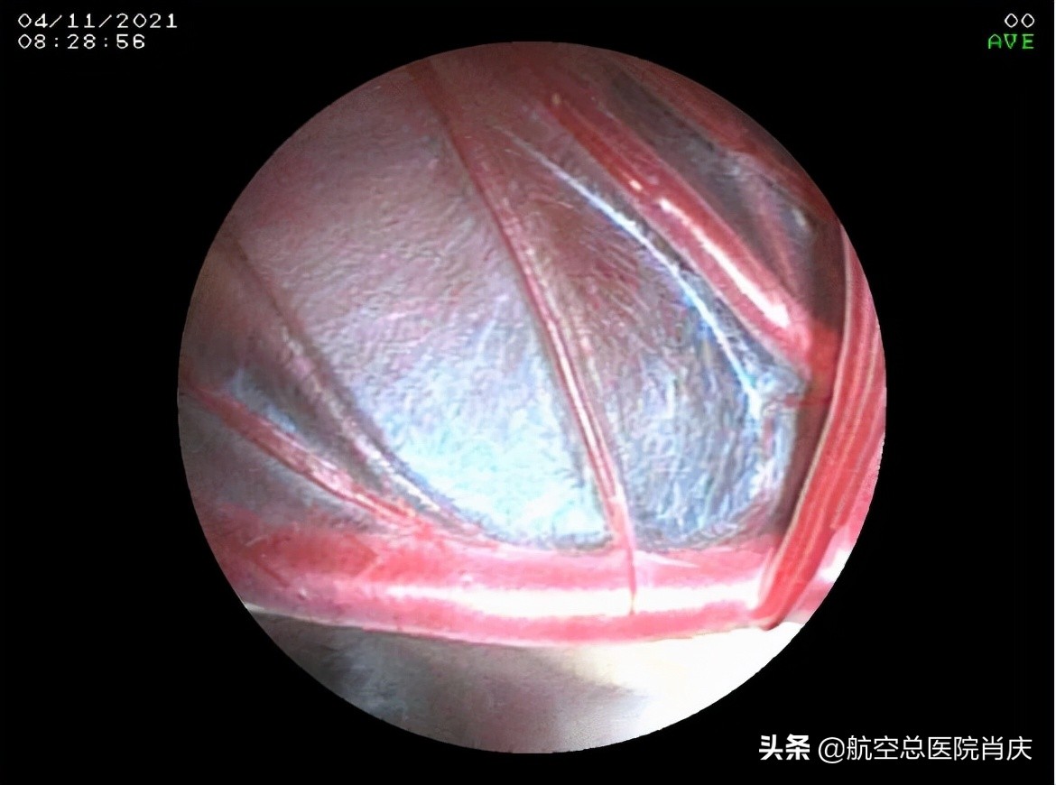 鞍上池蛛网膜囊肿手术费用,鞍上池蛛网膜囊肿影响智力吗