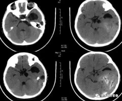 颅内有钙化怎么治疗,34岁脑部有钙化正常吗