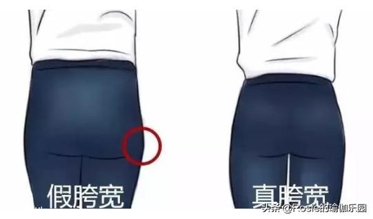 假胯宽怎么消除最有效,假胯宽是什么原因怎么治