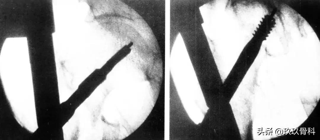 骨科取髓内钉的视频,骨科髓内钉内固定术式简写