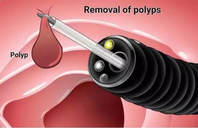 有肠息肉大便时有什么症状,除了痔疮出血还有什么会出血