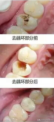 门牙龋坏了建议补牙还是做牙冠,龋坏补牙了还会坏吗