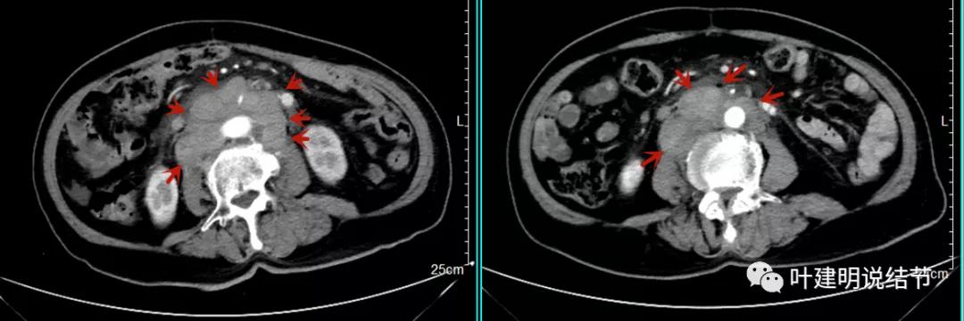 特瑞普利单抗食管癌成功案例,特瑞普利单抗治疗食管癌效果好吗