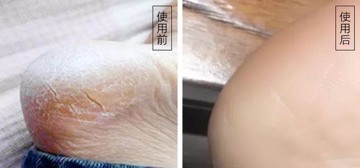 手脚干裂倒刺怎么治疗,手脚经常脱皮开裂最佳治疗方法