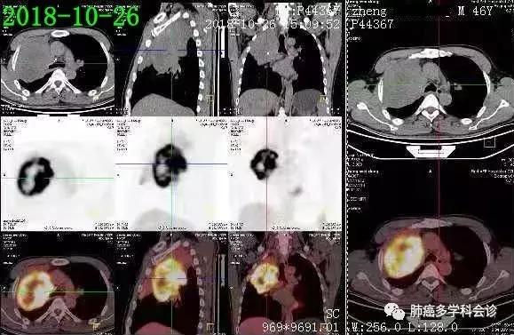 上海专家肿瘤治疗新探索,肿瘤诊疗一体化治疗方案