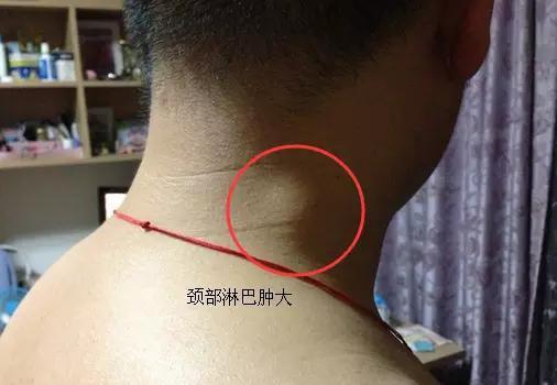 癌症怎么转移的,癌症是如何转移的