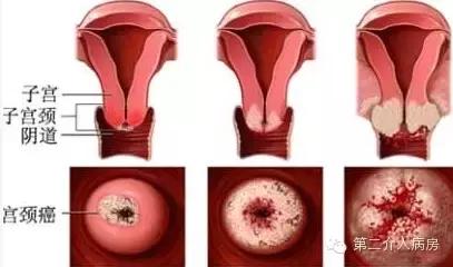 恶性肿瘤介入治疗是什么意思,良恶性肿瘤的介入治疗ppt