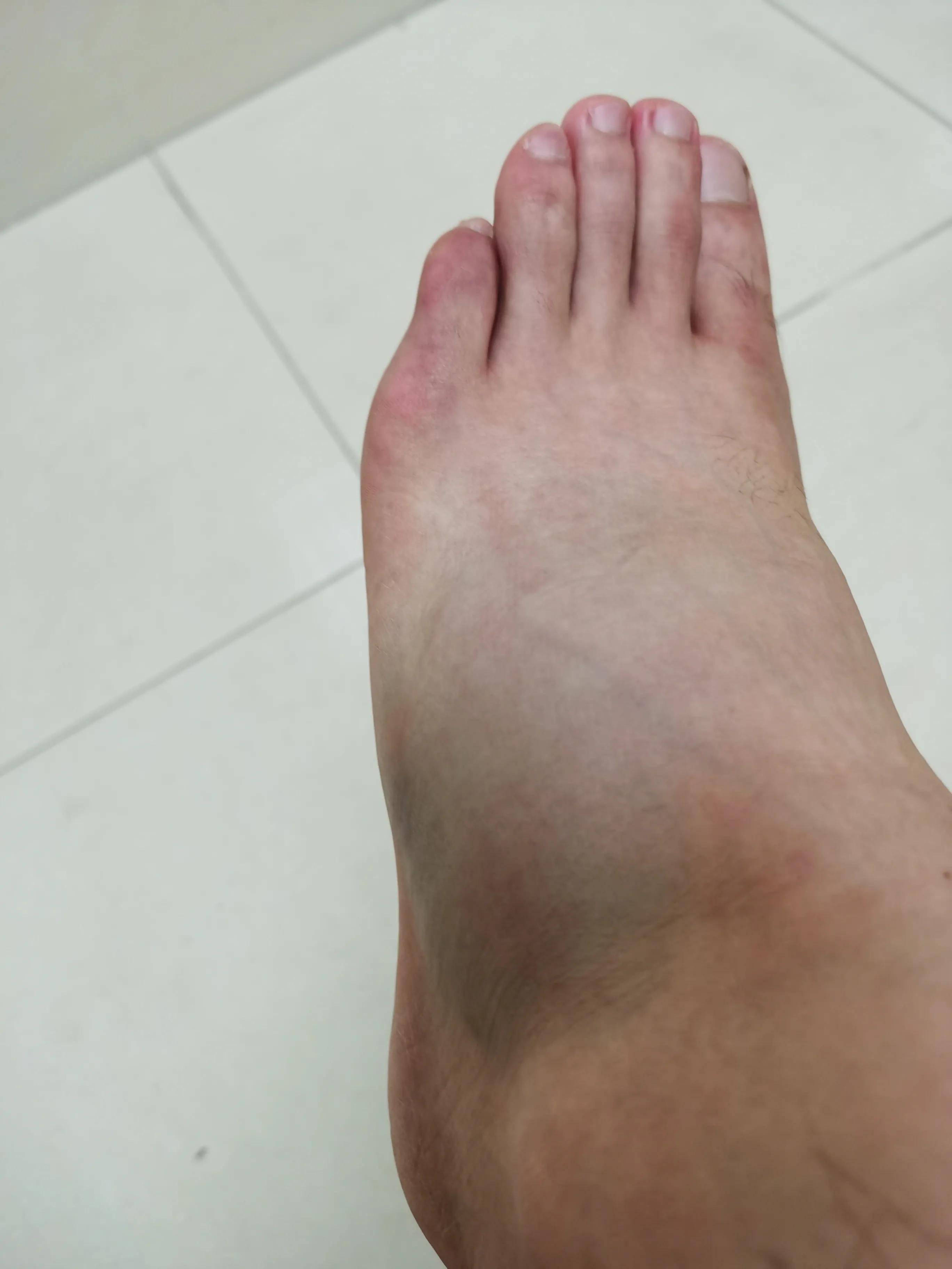 第五跖骨基底部骨折60天能走路吗,第五跖骨基底部骨折60天能脱拐吗