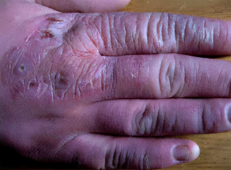 一到冬天就复发?小菌衣教你几招远离冻疮烦恼