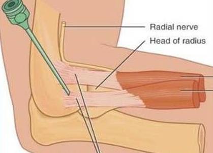 右胳膊上臂疼痛,胳膊游走性疼痛