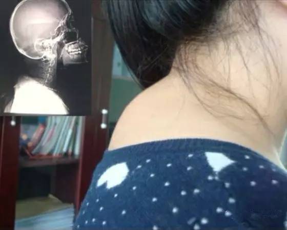 颈椎富贵包怎么做操可以缓解,颈椎突出一个包怎么快速恢复