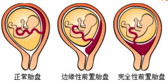 孕晚期足月出生注意事项,孕妇差不多需要提前进医院待产吗