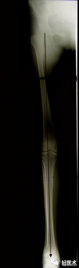 髓内钉技巧,髓内钉教学视频讲解