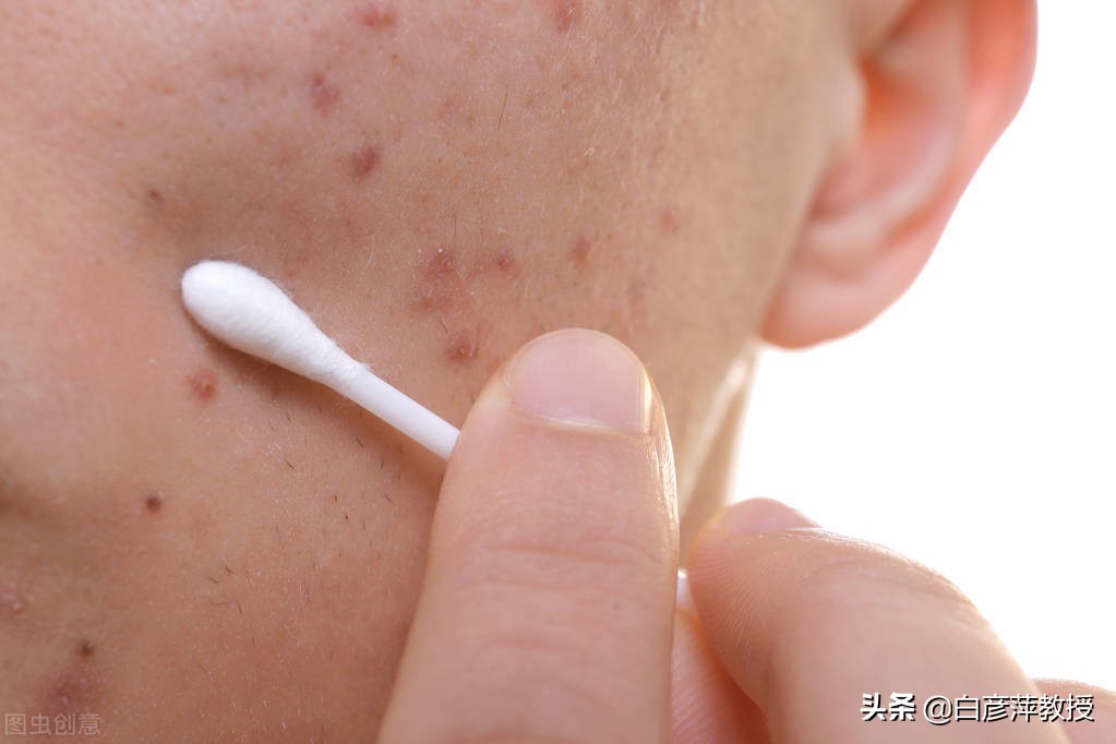 青春痘是不是痤疮的一种,青春痘是脂溢性皮炎吗