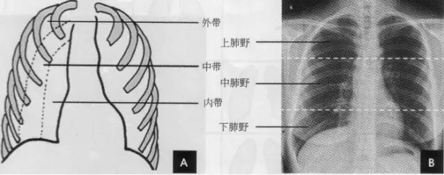 x线影像解剖大全,胸部x线怎么看懂图解