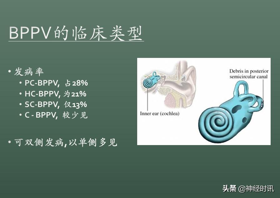 良性位置性眩晕诊断和治疗指南,良性阵发性位置性眩晕的诊断标准