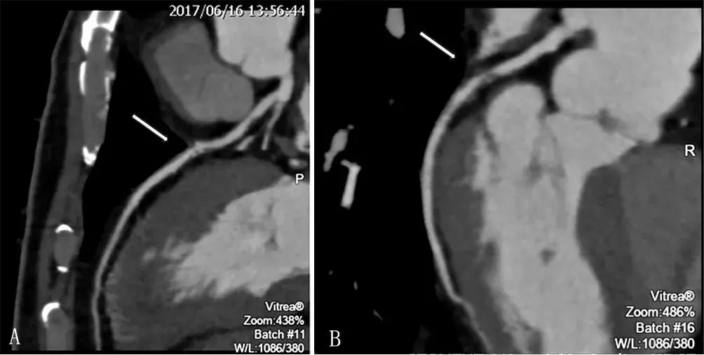 心肌梗死两年心电图正常怎么回事,心电图检查心肌梗死心肌酶正常
