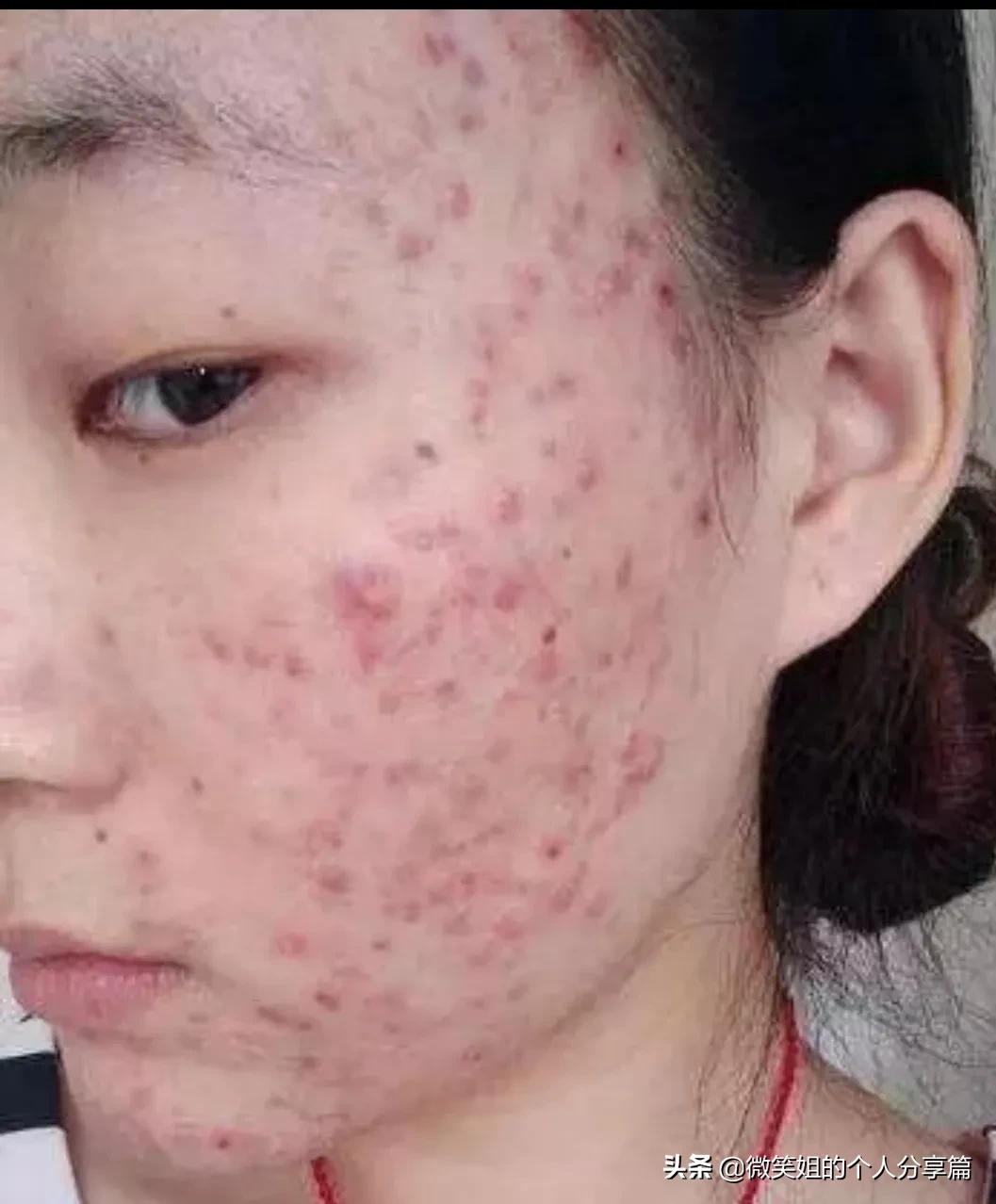 人中下巴反复长闭口粉刺,人中经常长痘痘怎么回事