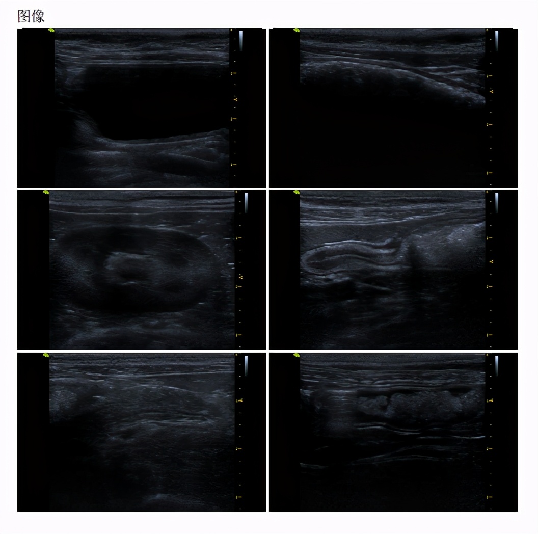 猫咪患ibd慢性肠炎怎么治疗,猫咪肠胃炎之后总是软便怎么调理
