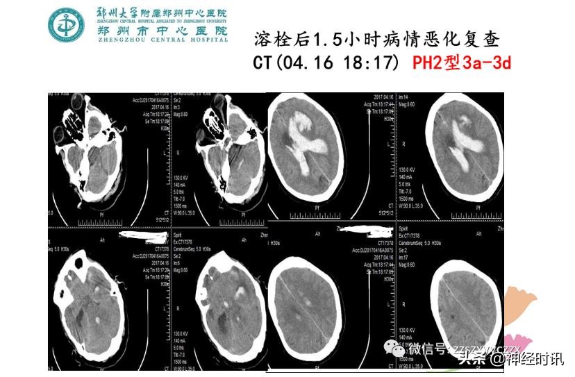 静脉溶栓怎么引起的,静脉相关并发症的预防及处理