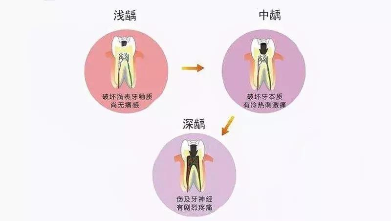 牙髓炎晚上牙疼怎么缓解疼痛,牙髓炎导致牙疼吃什么药