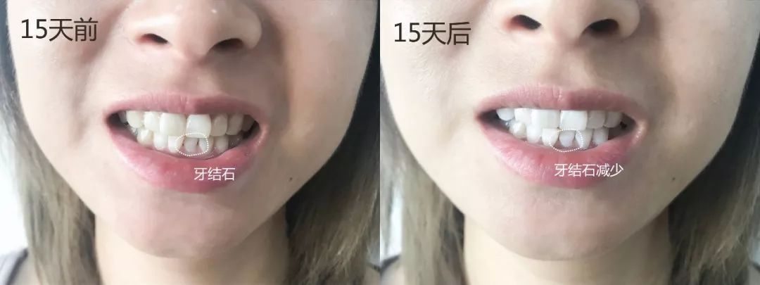 李佳琦巴氏刷牙,李佳琦口嚼式牙膏