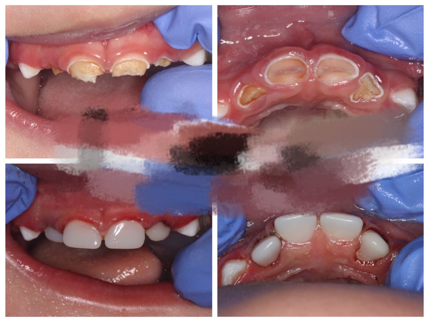 孩子乳牙龋齿有必要治疗吗,4颗龋齿怎么办