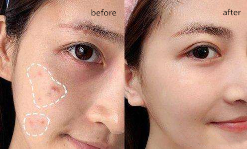 身上的螨虫会粘在衣服上吗,身上螨虫太多身体会烂么