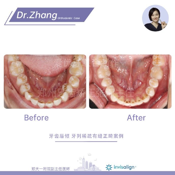 郑州矫正牙齿整形哪个医院好,郑州牙齿局部矫正