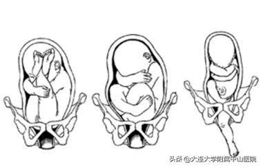 【科室推介】外倒转术:胎位不正也能顺产