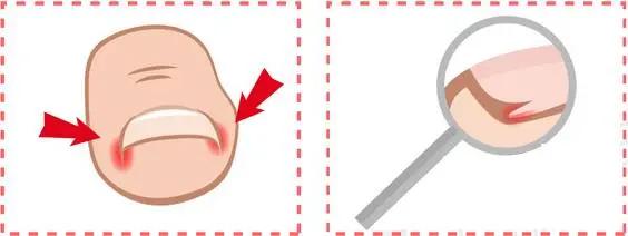 小知识一不小心扭伤脚了怎么处理,小脚趾指甲冷知识