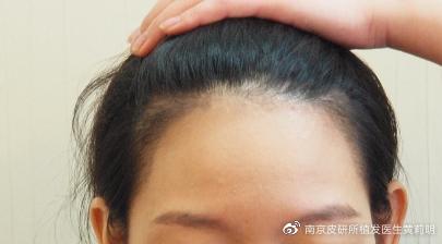 脱发烦恼怎么破几招化解头顶尴尬,头顶出油出汗脱发严重是怎么回事