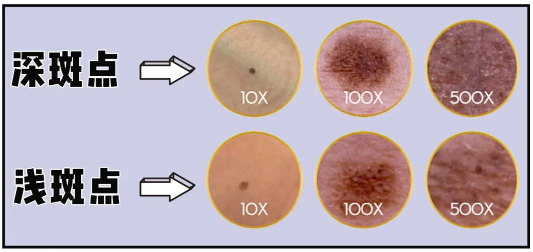 脸上的斑可以通过医美去掉吗,脸上长斑了能用激光去除吗