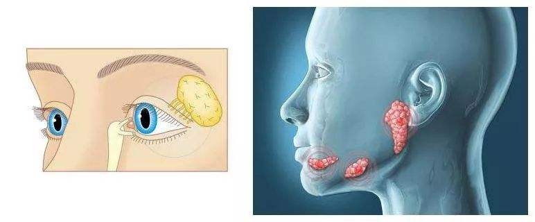 风湿病会引起口腔反复溃疡吗,风湿病引起的口腔溃疡吃什么药