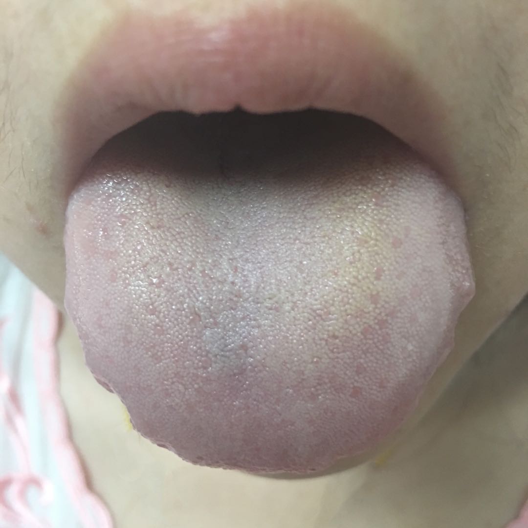 脸上湿疹一直反反复复,面部皮炎湿疹反反复复