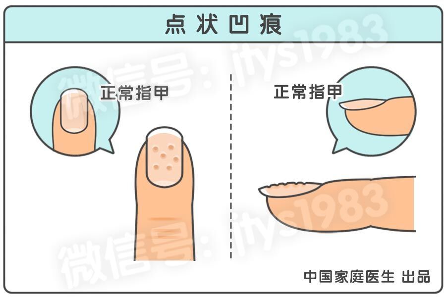 指甲上月牙少是什么问题,指甲月牙少了怎么回事