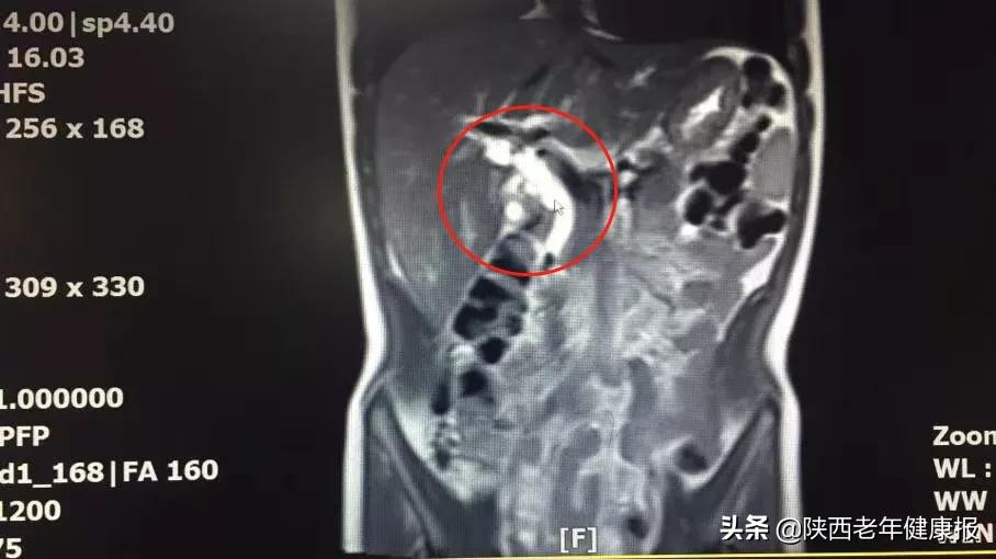 如何区分胃疼和胰腺疾病,半夜经常胃痛跟胰腺有关吗