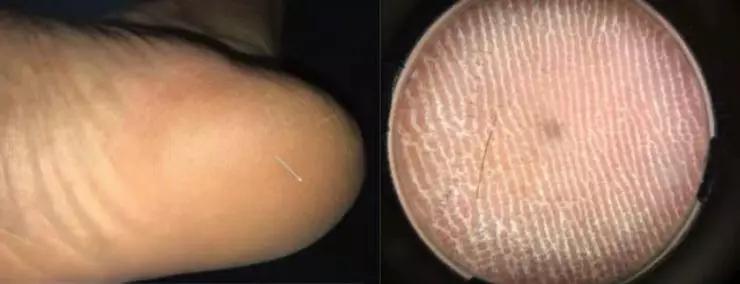 男子生殖器自燃的新闻,男性生殖器着火