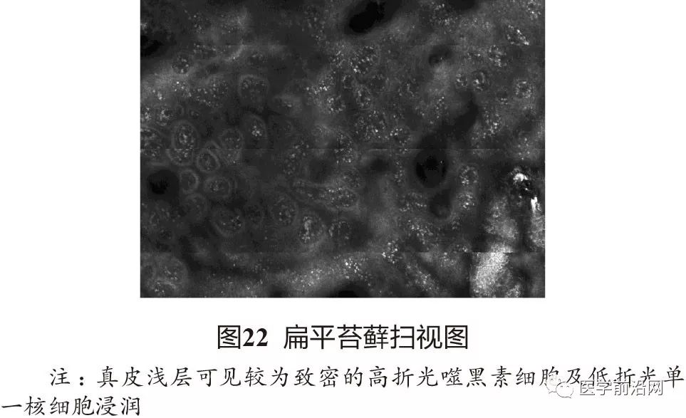 炎症性皮肤病反射式共聚焦显微镜诊断特征专家共识全文发布