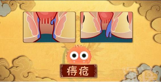 长时间蹲厕所得痔疮怎么治,得痔疮会让人老得快