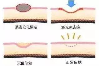 点痣医生,医院医生点痣视频