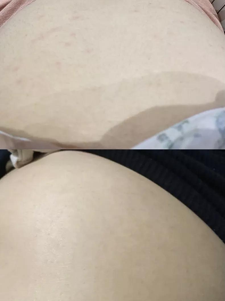 长胎不长肉会长妊娠纹么,孕期长胎不长肉视频