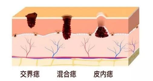 中医院点痣方法,中医治疗点痣