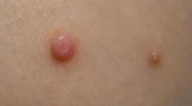 16岁男孩脸上长青春痘了怎么办,12岁男孩子脸上长满青春痘怎么办