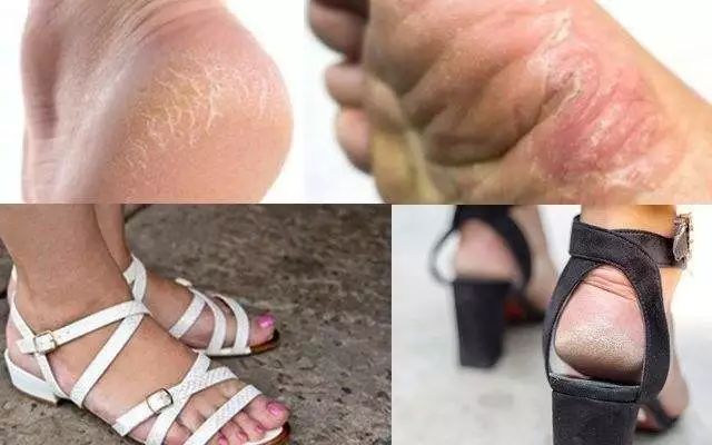 脚气特别痒用什么泡脚效果好,脚气脚臭脚痒的克星用什么